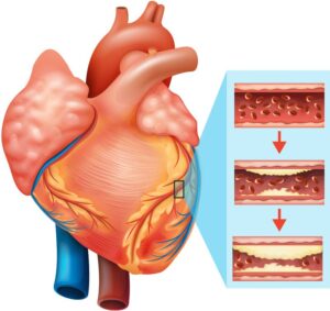 động mạch vành còn được gọi là bệnh tim