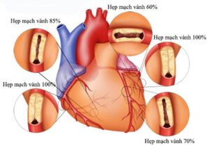 động mạch vành gây nhồi máu cơ tim